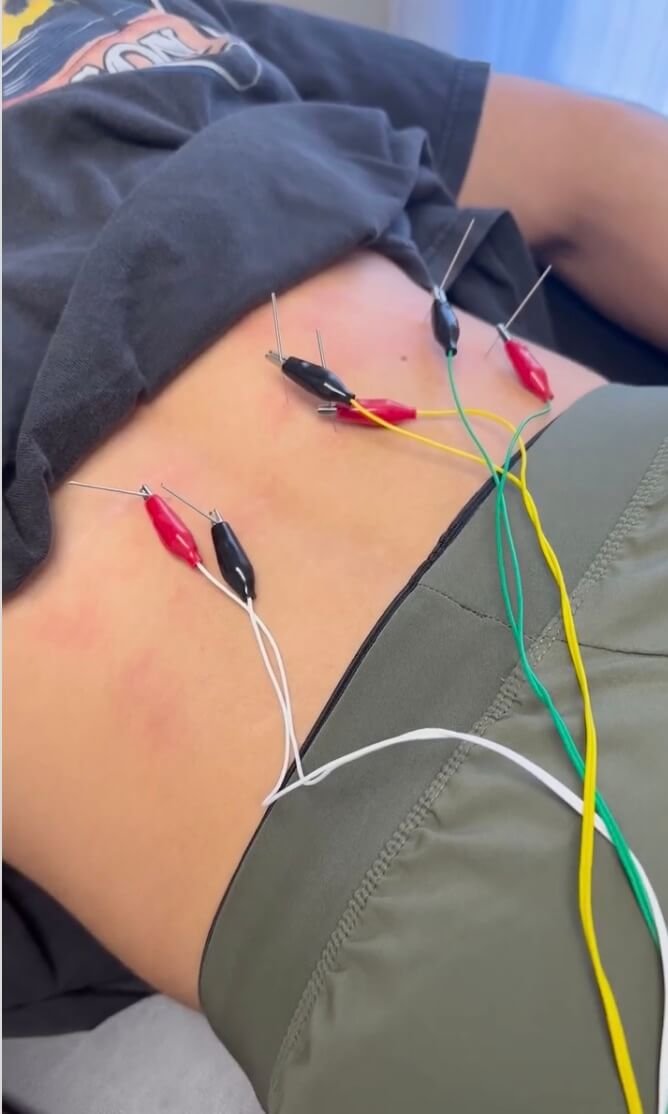 Βελονισμός – Dry Needling